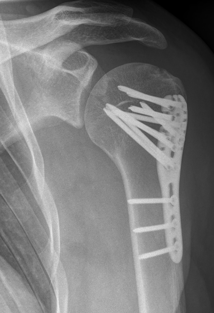 röntgenaufnahme oberarmbruch versorgung